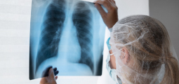 Visão em perspectiva traseira de uma profissional de saúde vestindo uma touca descartável transparente na cabeça, máscara cirúrgica protetora e avental. Ela segura firmemente com as duas mãos uma folha grande de filme de radiografia (raio-X) contra uma janela iluminada. A imagem médica exibe com nitidez a caixa torácica de um paciente, revelando as costelas, os pulmões e a silhueta central do coração.